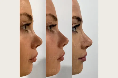 فیلر بینی و هر آنچه پیش از تزریق باید بدانید